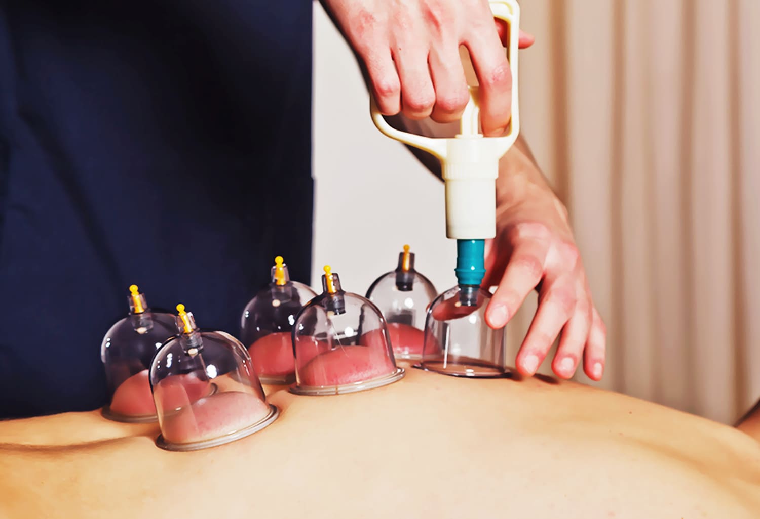 From Exhaustion to Barakah Reviving the Sunnah of Hijama for Physical, Mental, and Spiritual Well-Being