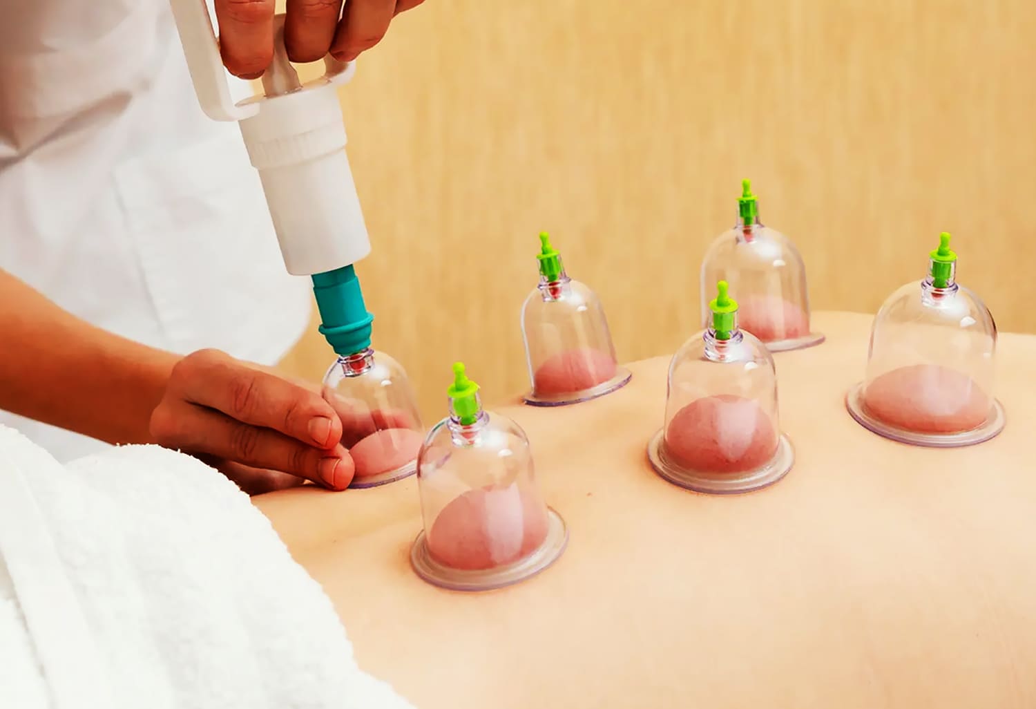 Wet Cupping Singapore is A Prophetic Therapy for Healing, Prevention, and Holistic Health