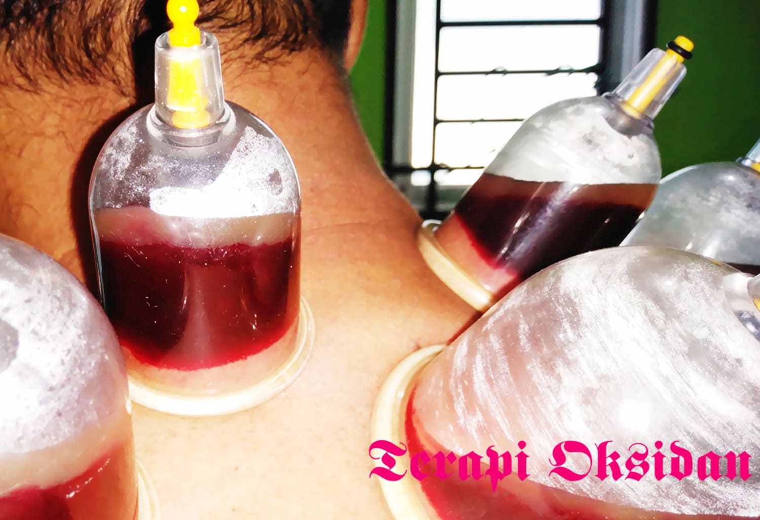 Wet Cupping Singapore Near Me, Key Differences from Dry and Wet Cupping Singapore